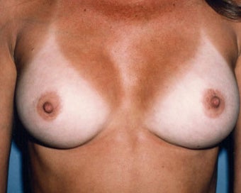Breast Augmentation Achieves Fullness