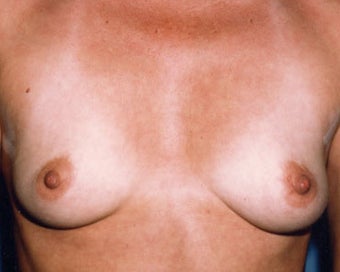 Breast Augmentation Achieves Fullness
