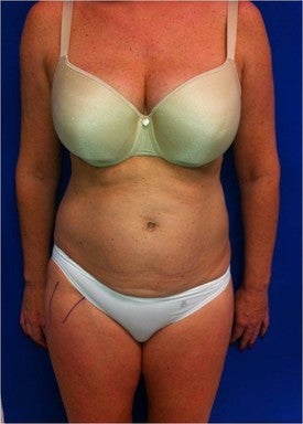 Laser Lipo