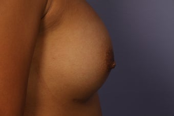 Inverted Nipple Repair