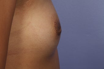 Inverted Nipple Repair