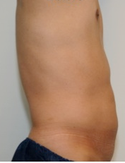 Male Liposuction Before and After - 3 Months