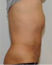 Male Liposuction Before and After - 3 Months