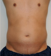 Male Liposuction Before and After - 3 Months