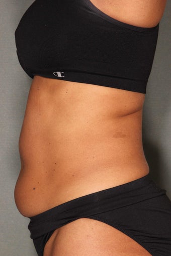 54 Year Old Female Treated for UnWanted Fat With SmartLipo and Vaser Laser High Deffinition 