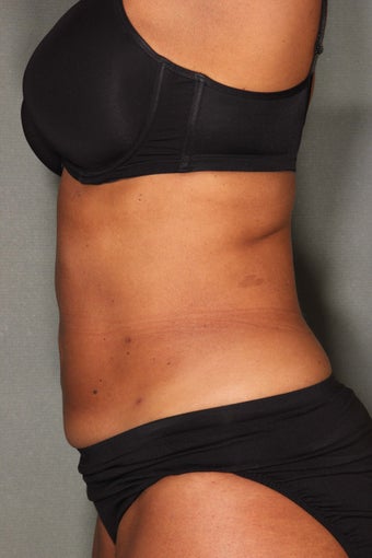 54 Year Old Female Treated for UnWanted Fat With SmartLipo and Vaser Laser High Deffinition 