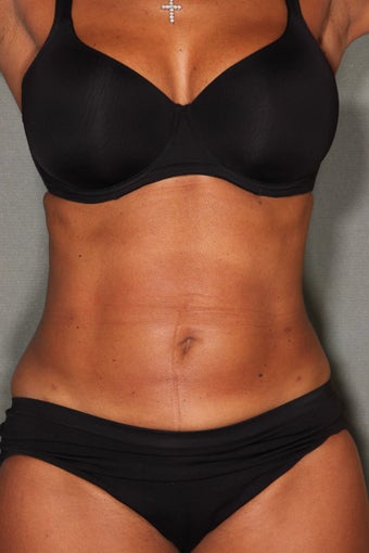 54 Year Old Female Treated for UnWanted Fat With SmartLipo and Vaser Laser High Deffinition 