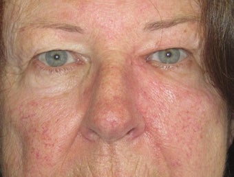 Eyelid and cheek basal cell carcinoma