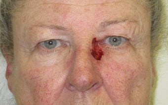 Eyelid and cheek basal cell carcinoma