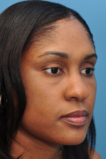 Rhinoplasty