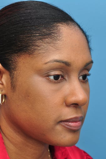 Rhinoplasty