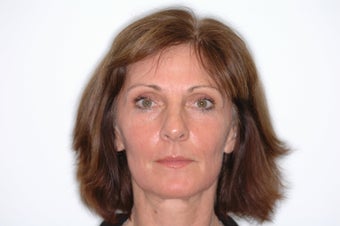 Fraxel repair CO2 laser resurfacing