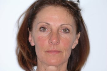 Fraxel repair CO2 laser resurfacing
