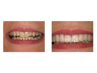 Porcelain Veneers