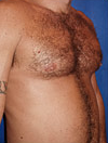 Pec Implants 