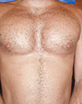 Pec Implants 