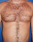 Pec Implants 