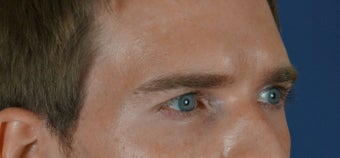 27 year old treated with filler to improve the hallowness in the temples