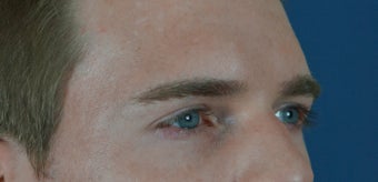 27 year old treated with filler to improve the hallowness in the temples