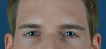 27 year old treated with filler to improve the hallowness in the temples