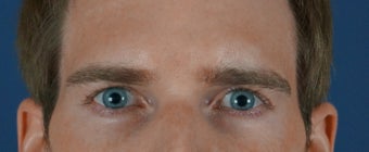 27 year old treated with filler to improve the hallowness in the temples