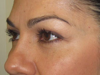 42 year old female with eyelid bags