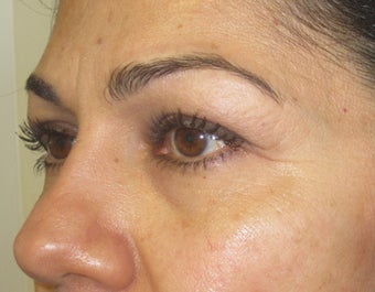 42 year old female with eyelid bags