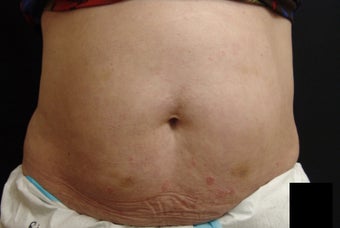 Coolsculpting