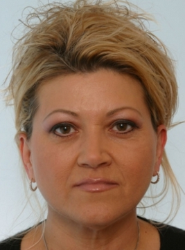 Restylane 