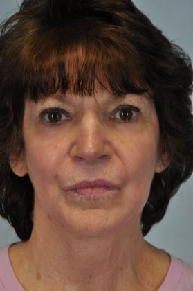 Full Face Hetter Peel