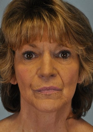 Full Face Hetter Peel