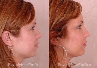Revision Rhinoplasty