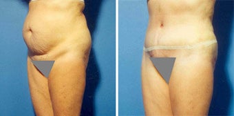 Abdominoplasty