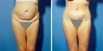 Abdominoplasty