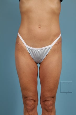 Thigh Lift Patient