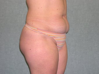 SmartLipo