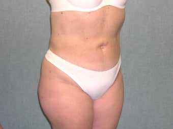 SmartLipo