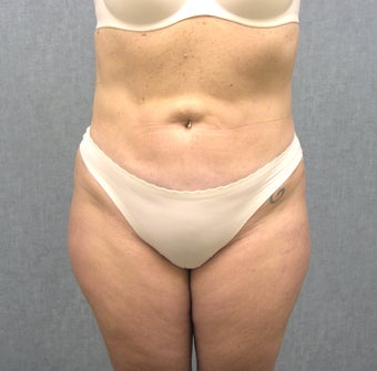 SmartLipo