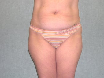 SmartLipo