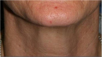 55 Year old female with aging neck due to neck bands.  She doesn't want a surgical neck lift