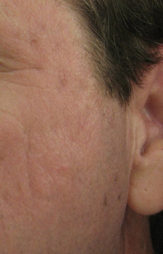 Fraxel repair for acne scars