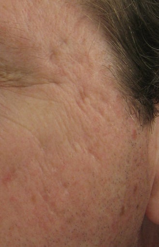 Fraxel repair for acne scars