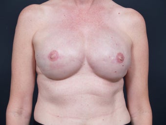 51 Year Old Feamale for Breast Reconstruction
