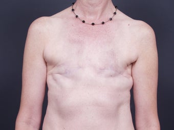 51 Year Old Feamale for Breast Reconstruction