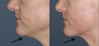 Ultherapy for under chin in 43 year old female