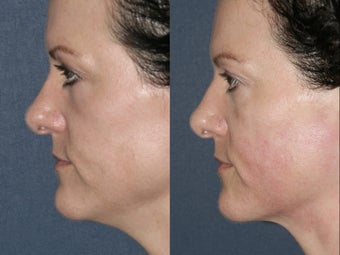 Ultherapy for under chin in 43 year old female