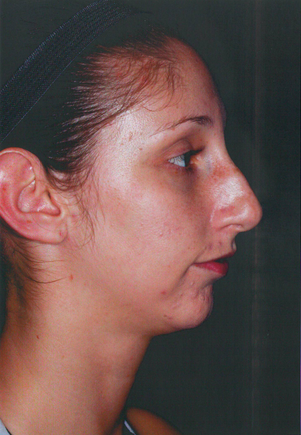 Chin Augmentation
