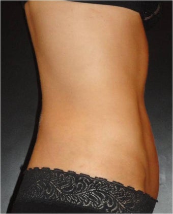 SmartLipo MPX with Pro-Sculpt
