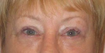 Upper and lower lid blepharoplasty, ptosis repair, chemical peel to lower lids