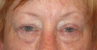 Upper and lower lid blepharoplasty, ptosis repair, chemical peel to lower lids